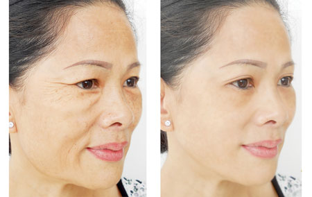 Xay nhuyễn nắm lá tía tô theo cách này, xóa mờ nếp nhăn, thâm sạm trên da mặt cực nhanh ảnh 5 Xay nhuyễn nắm lá tía tô theo cách này, xóa mờ nếp nhăn, thâm sạm trên da mặt cực nhanh ảnh 5