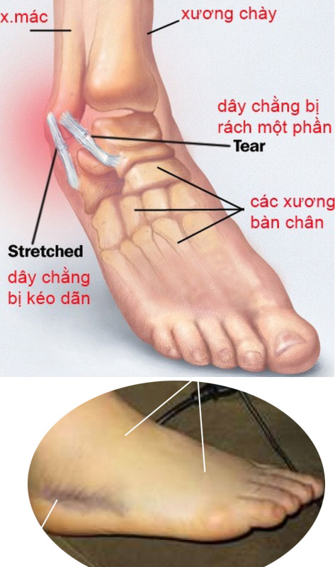 Cách sơ cứu bong gân đúng cách để tránh ảnh hưởng đến xương khớp sau này ảnh 2 Cách sơ cứu bong gân đúng cách để tránh ảnh hưởng đến xương khớp sau này ảnh 2