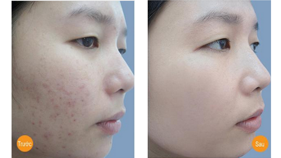 Dùng Vitamin C dưỡng da theo cách này, mụn chi chít khắp mặt dai dẳng cỡ nào cũng trị dứt ảnh 4 Dùng Vitamin C dưỡng da theo cách này, mụn chi chít khắp mặt dai dẳng cỡ nào cũng trị dứt ảnh 4